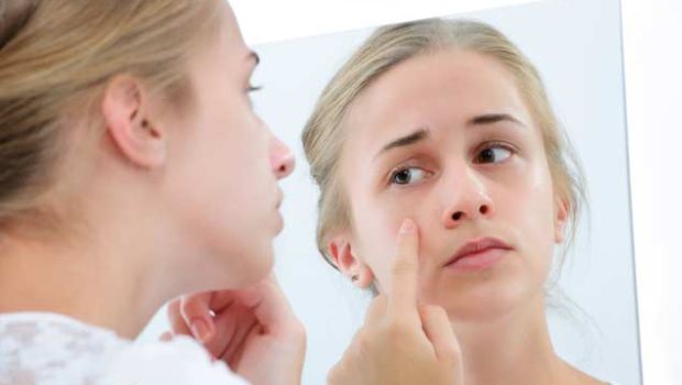 What is the problem of pimples?  So take these 6 tips